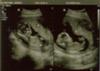 Twins A & B!!!  Almost last time they both will fit on one sono!!!