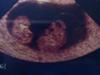 My Twin babies.... 9 wks 0 days :)