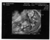 Two found at ten weeks