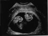 Our Twins at 8 wks!