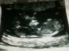 baby A at11wks 