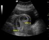 8 week- twins