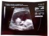 12 week ultrasound