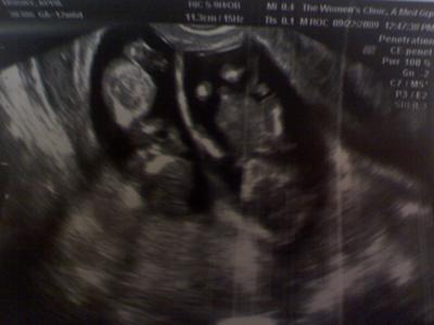Baby B on Left, Baby A on right.  We found out Baby B was a boy on this date!
