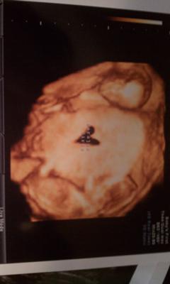Twin Fraternal Girls - 15 Weeks 3D Ultrasound