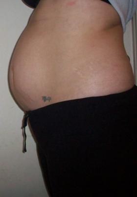 Twin Pregnancy At 11 Weeks 4 Days