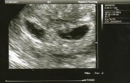 Pictures ultrasound missed twin Missed miscarriage