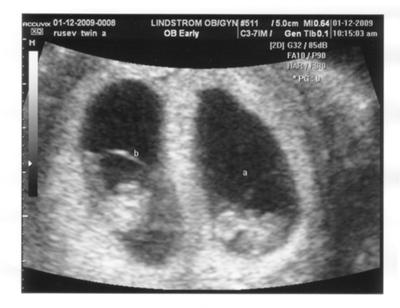 Twins 7 week ultrasound Can Twins
