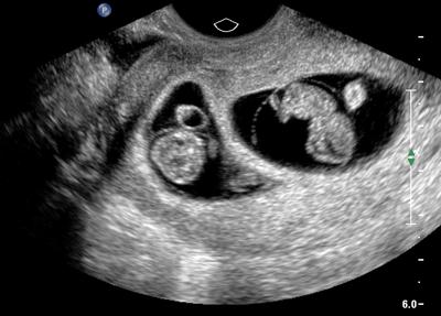 Images ultrasound twin pregnancy Can a
