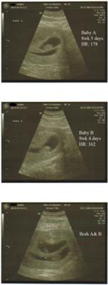 twins ultrasound 9 weeks 21268801