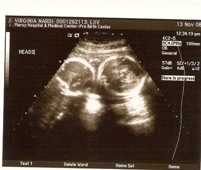 23 недели двойня. УЗИ двойни на 23 неделе беременности. УЗИ 22 недели беременности двойня. УЗИ 15 недель беременности двойня. УЗИ 13 недель беременности двойня.