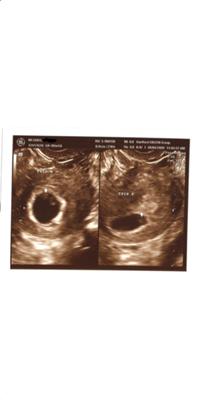 Twin A & B  U/S @ 6 weeks 5 days 