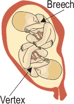 Breech/Vertex Twins