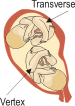 Transverse/Vertex Twins