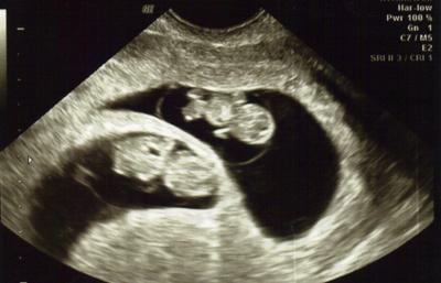 My Twins Ultrasound 9 Weeks