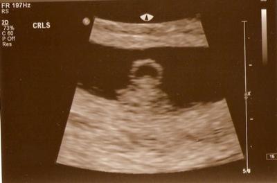 Our first sonogram (both babies and yolk)