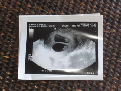Twin Ultrasound At 8 Weeks 2 Days