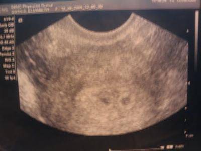 Ultrasound at 4 weeks