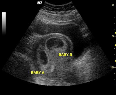 Twins - 8 Week Ultrasound